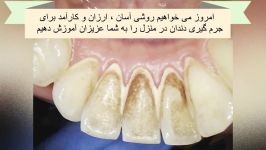 جرم گیری دندان در خانه  سفید کردن دندان  دیگر نیازی به پرداخت