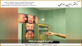 جراحی بینی  Rhinoplasty  دکتر امین ادهمی