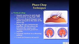 Phaco Chop