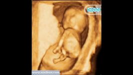 سونوگرافی چهار بعدی در بارداری هفته یازدهم3