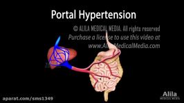انیمیشن فشار خون ورید پورتportal hypertension