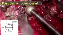 جراحی میکروسکوپی نورینوم عصب 9 اپروچ اینفراکوکئار