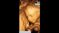 سونوگرافی چهار بعدی در بارداری هفته بیستم