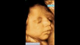 سونوگرافی چهار بعدی در بارداری هفته سی دوم
