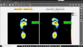 پیشگیری زخم پای دیابتی آنالیز فشار پا