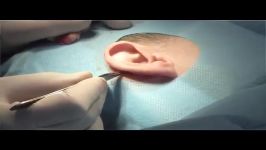 جراحی زیبایی گوش یا عمل اتوپلاستی