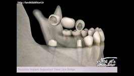 ایمپلنت دندان بریج های دندانی