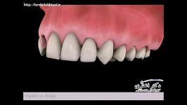 مقایسه بریج دندانی ایمپلنت دندان
