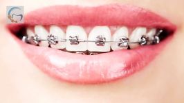 سفید کردن دندانها بعد ارتودنسی  دکتر مسعود داوودیان