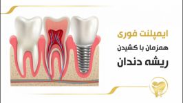 ایمپلنت فوری همزمان کشیدن ریشه دندان
