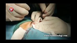 جراحی سنگین افتادگی پلک چشم در اتاق عمل بیمارستان ساسان