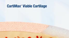 CartiMax® Viable Cartilage Allograft  Product Video