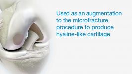 Cartilage Allograft Matrix