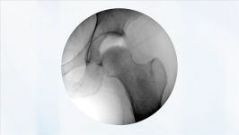 Dr. Laskovski  Endoscopic Gluteus Medius Repair Using Y Knot® RC