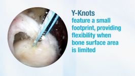 Y Knot® All Suture Anchor Family  Product Video