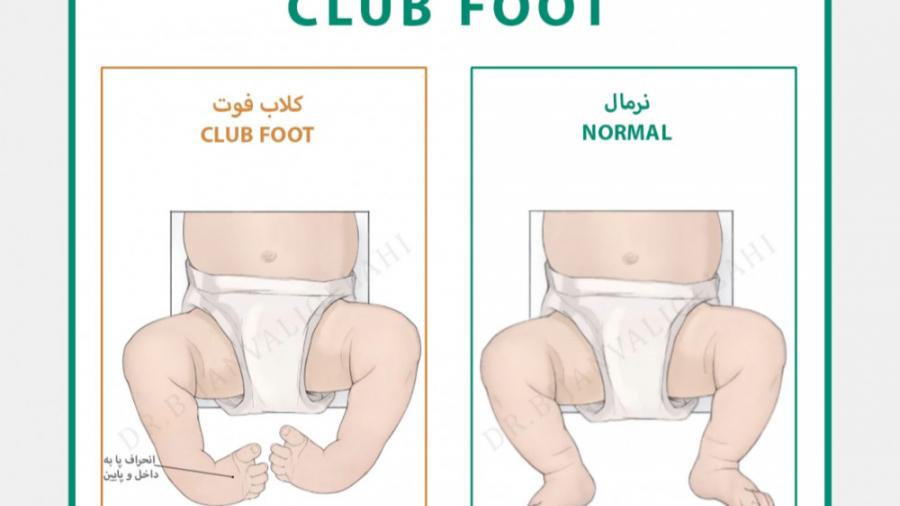 کلاب فوت پاچنبری   Club foot