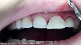 کامپوزیت ونیر دندانهای قدامی قسمت سوم دکتر قربانیان 