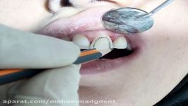 کامپوزیت ونیر دندانهای قدامی قسمت چهارم دکتر قربانیان 