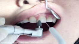 کامپوزیت ونیر دندانهای قدامی قسمت ششم دکتر قربانیان 