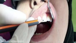 کامپوزیت ونیر دندانهای قدامی قسمت پنجم دکتر قربانیان 