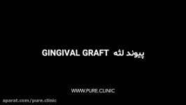 پیوند لثه Gingival Graft