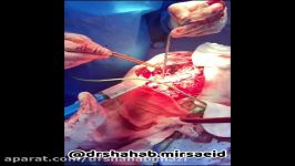 کلیپ پزشکی عمل اورژانسی جراحی مغز توسط دکتر میرسعید،جراح مغزواعصاب 26712439