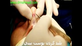 فیلم عمل جراحی بینی گوشتی بهترین جراح زیبایی بینی