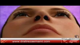 Rhinoplasty surgery animation by dr.emami