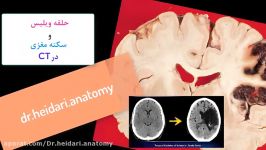 آموزش آناتومیک سی تی اسکن مغز سکته مغزی