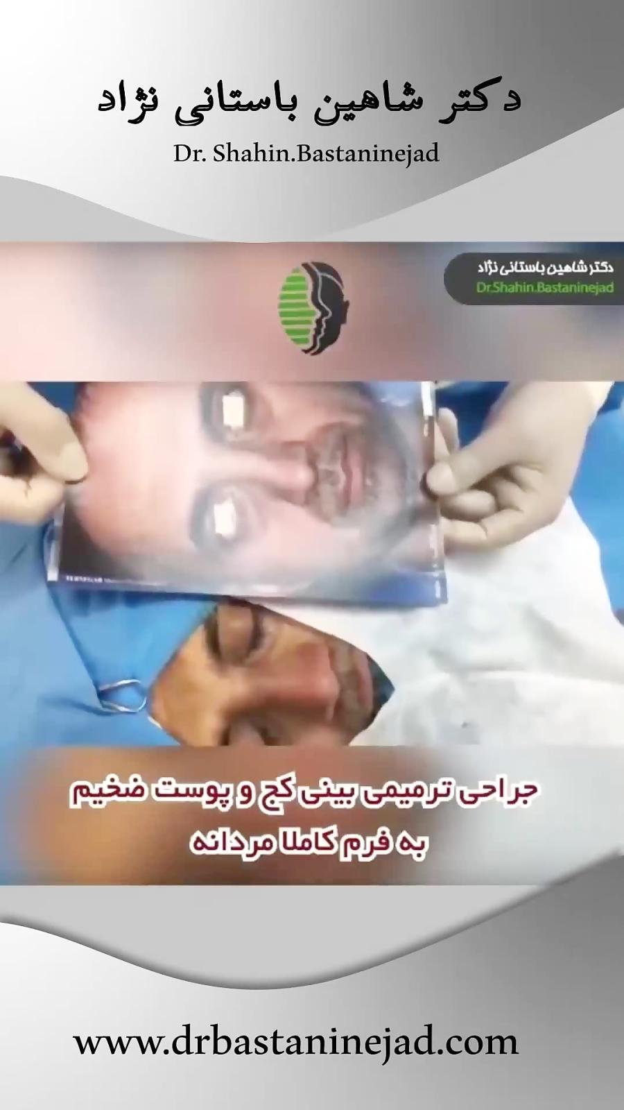 نمونه های جراحی ترمیمی بینی  دکتر شاهین باستانی نژاد بهترین جراح بینی تهران