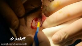 عمل جراحی پلک جراحی بلفاروپلاستی