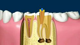 ویدیوی جالبی مراحل درمان ریشه دندان عصب کشی دندان