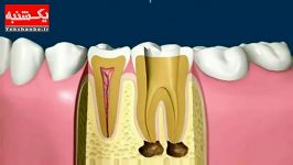 مراحل عصب کشی روکش دندان