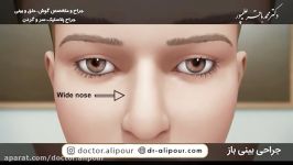 فیلم جراحی بینی باز  جراحی زیبایی بینی ارومیه  دکتر علیپور