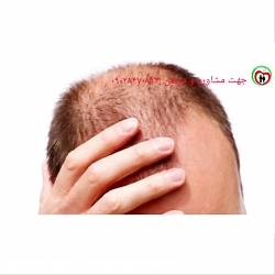 علت های مختلف ریزش مو چیست؟