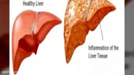 هشت نشانه کبد شما در حال بیمار شدن است