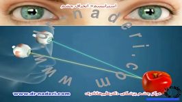استرابیسم انحراف چشم مرکز چشم پزشکی دکتر علیرضا نادری