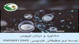 لوپوس چیست چگونه درمان می شود؟