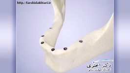 جایگزینی دندان مصنوعی ایمپلنت دندان