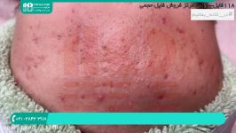 پاکسازی صورت  آموزش پاکسازی پوست  برداشتن جوش آکنه