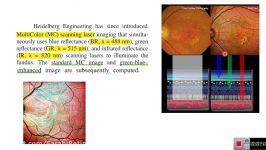 Multucolor Imaging in CSC