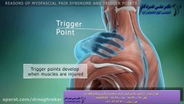 گره های عضلانی یا نقاط ماشه ای