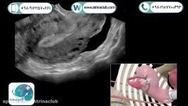 سونوگرافی ترانس واژینال جستجوي حاملگی خارج رحمEP