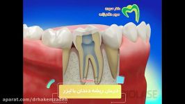 چگونگی درمان ریشه دندان لیزر