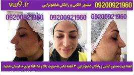 هایفوتراپی رفع چین چروک صورت بدن