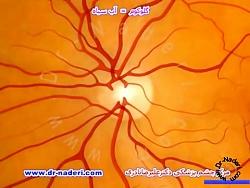گلوکوم یاآب سیاه چیست؟ مرکز چشم پزشکی دکتر علیر ضانادری