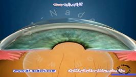 گلوکوم زاویه تنگ  مرکز چشم پزشکی دکتر علیرضا نادری