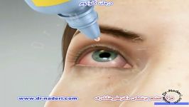 درمان گلوکوم آب سیاه مرکز چشم پزشکی دکتر علیرضا نادری