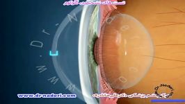تست های تشخیصی گلوکوم مرکز چشم پزشکی دکتر علیرضا نادری