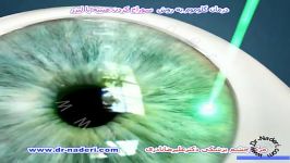 درمان گلوکوم بالیزرایریدوتومی مرکز چشم پزشکی دکترنادری